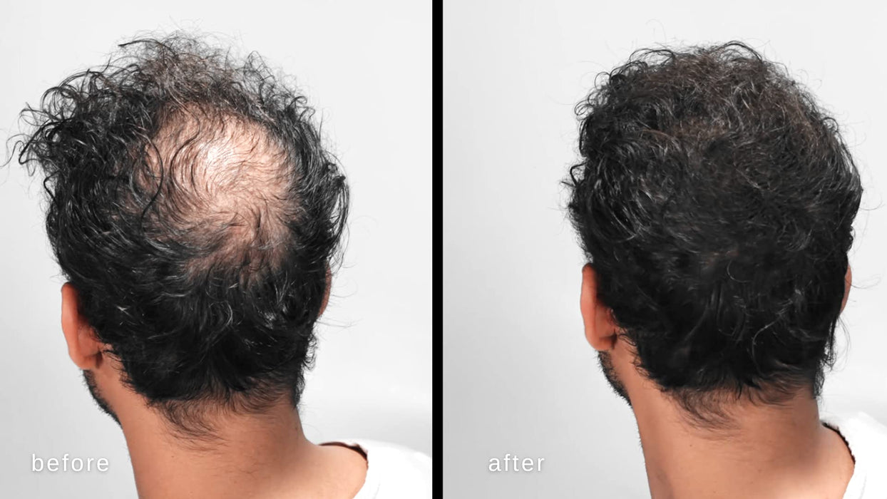 Włókna Zagęszczające Włosy Luxe - Zaufanie W Słoiku - 2 Miesiące + Dostawa! - Hipoalergiczny, Przetestowany Dermatologicznie - Dostępne W Wielu Kolorach (Czarny)