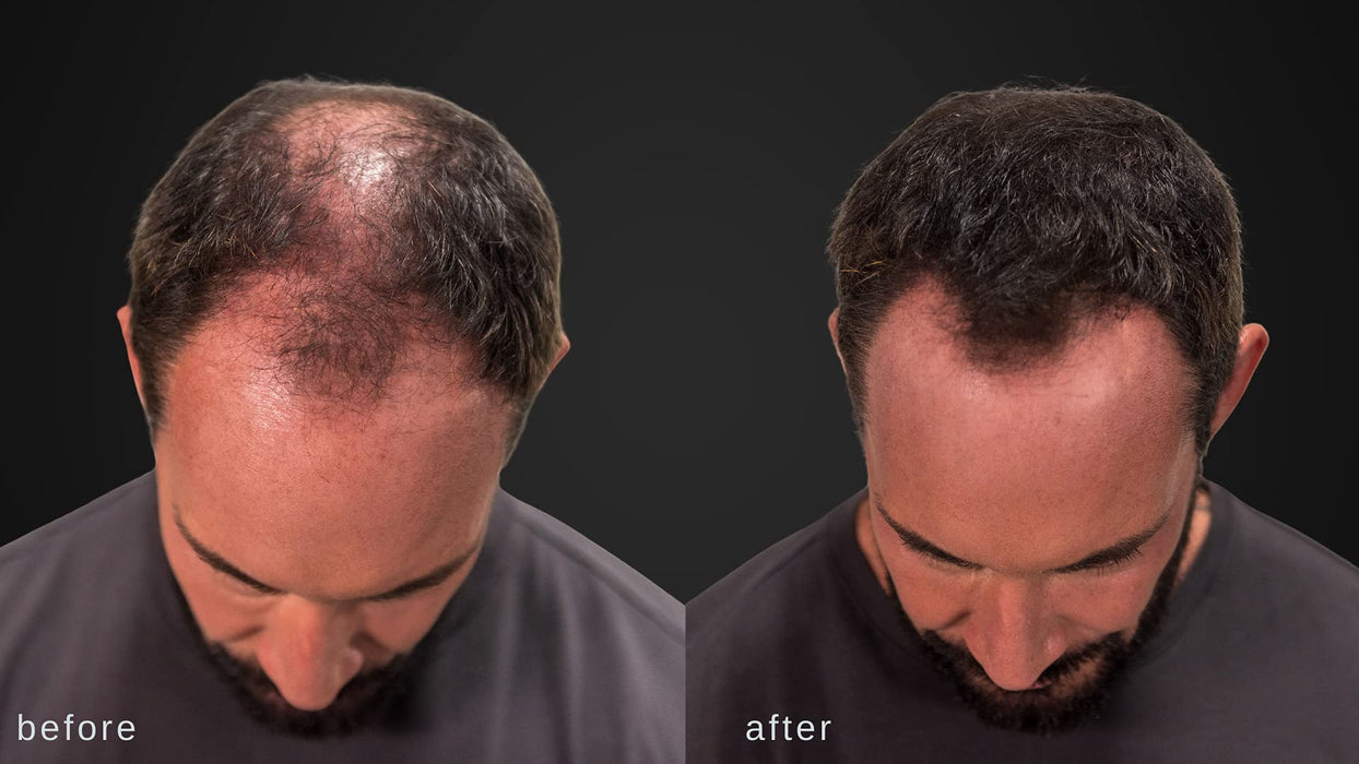 Włókna Zagęszczające Włosy Luxe - Zaufanie W Słoiku - 2 Miesiące + Dostawa! - Hipoalergiczny, Przetestowany Dermatologicznie - Dostępne W Wielu Kolorach (Czarny)