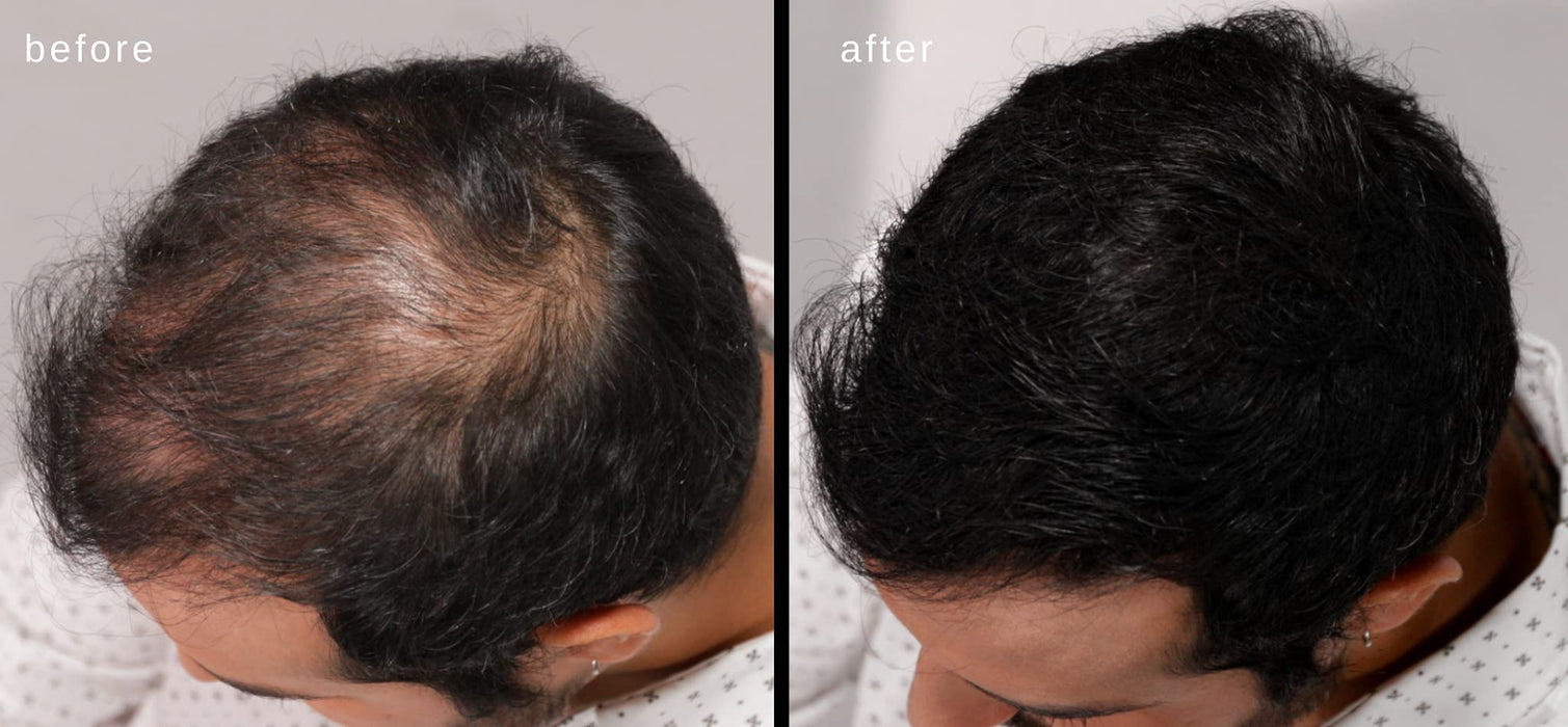Włókna Zagęszczające Włosy Luxe - Zaufanie W Słoiku - 2 Miesiące + Dostawa! - Hipoalergiczny, Przetestowany Dermatologicznie - Dostępne W Wielu Kolorach (Czarny)
